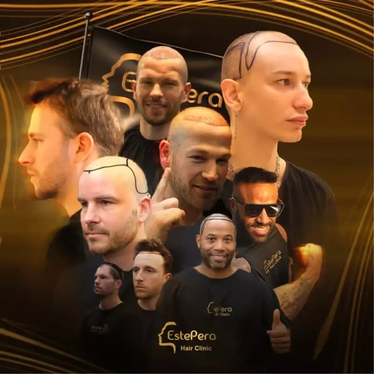 hair transplant in turkey why estepera leads the way in dhi sapphire fue and fue techniques QyqX6YiB.jpg